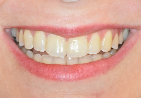 After clear aligners in Germantown, TN