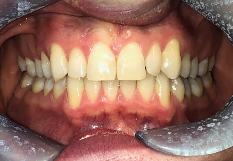 After using clear aligners in Germantown, TN