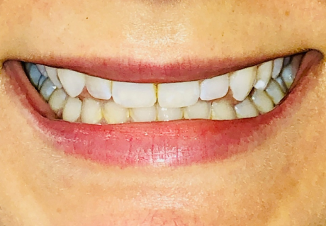 After clear aligner treatment