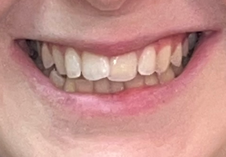 Before clear aligners in Germantown, TN