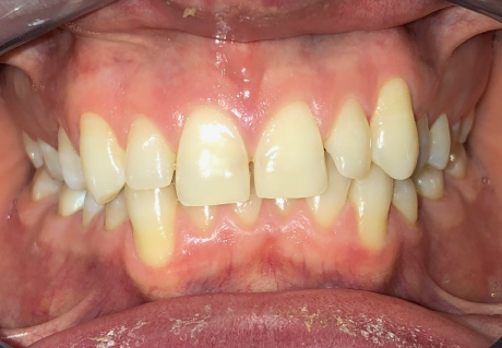 Before using clear aligners in Germantown, TN