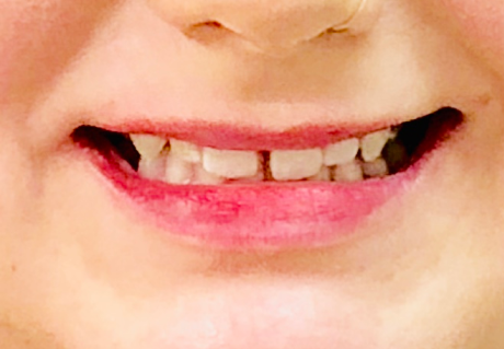 Before clear aligner treatment