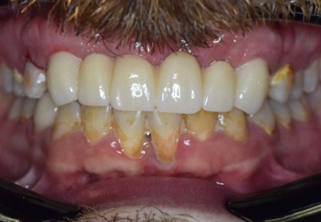 After cosmetic dentistry in Germantown, TN