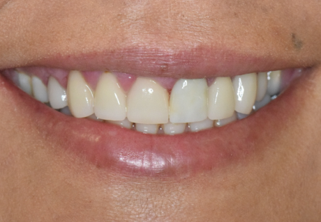 After Dental Veneers in Germantown, TN