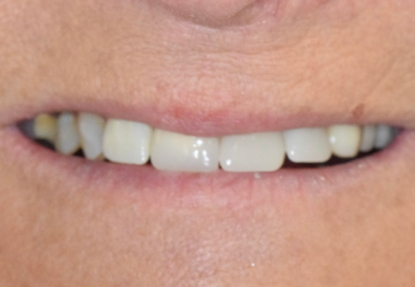 After Receiving dental veneers in Germantown, TN