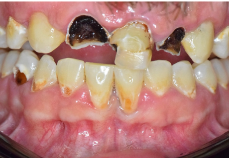 Before Cosmetic Dentistry in Germantown, TN