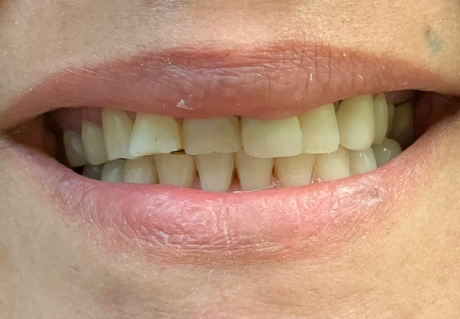 Before dental veneers in Germantown, TN