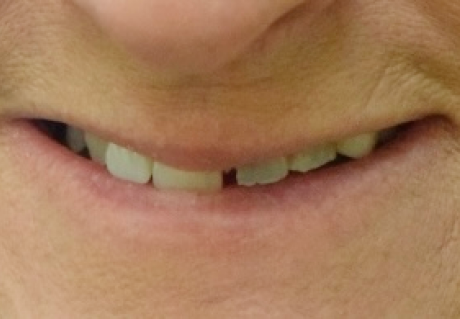 Before Receiving Cosmetic Dentistry in Germantown, TN