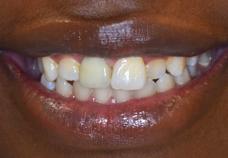 After dental implant crown