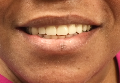 After dental implants in Germantown, TN