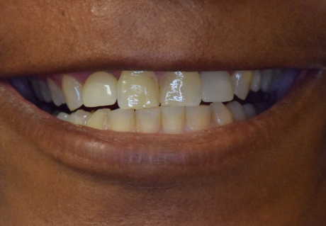 After receiving dental implants in Germantown, TN