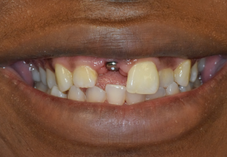 Before Dental Implant Crown