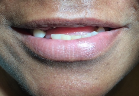 Before dental implants in Germantown, TN